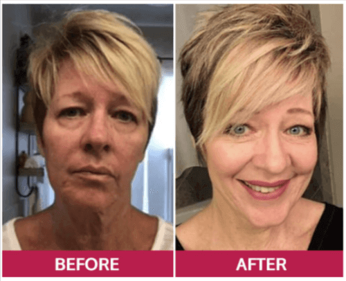 LunaSkin Before And After
